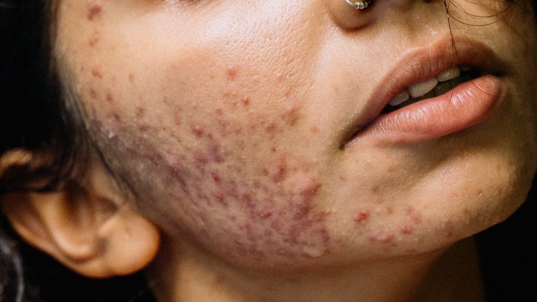How to treat hormonal acne with Korean skincare