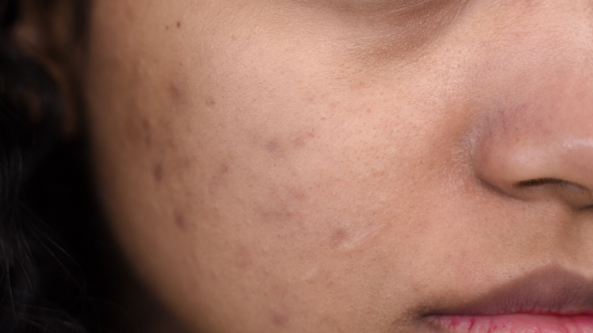 Best Korean serums for hyperpigmentation