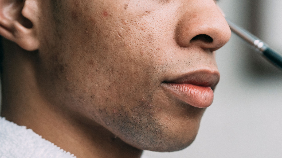 Korean skincare products for cystic, deep acne